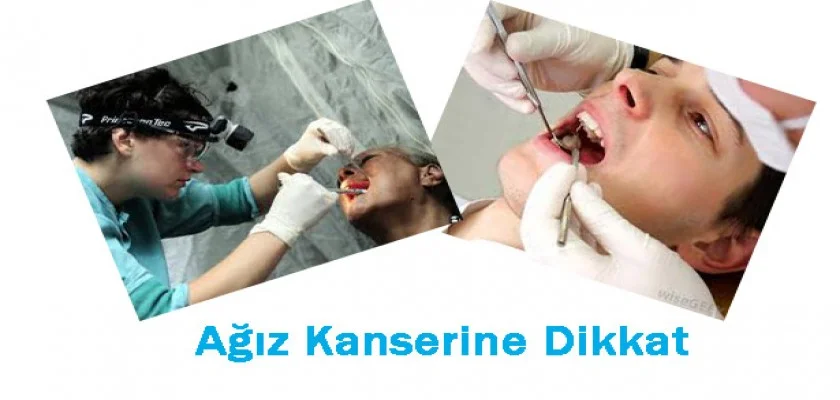 Ağız Kanserine Dikkat