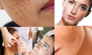 Melasma Tedavisi Nedir?