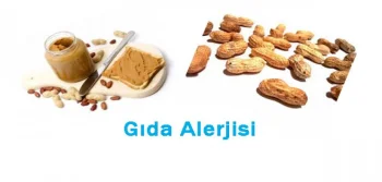 Gıda Alerjiniz Olabilir