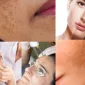Melasma Tedavisi Nedir?