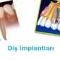 Diş İmplantları