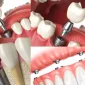 The Way to Reclaim Your Implant Smile